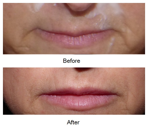 Before and after lip treatment