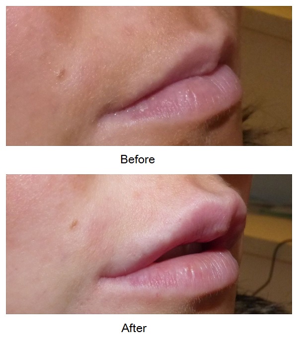 Fuller projected lips