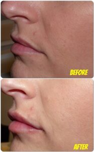 Lips .5 juvederm
