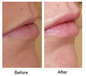 Before and after lip treatment