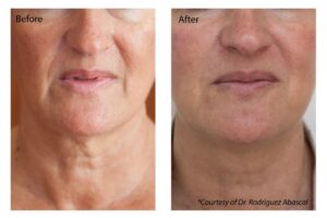 Profhilo before and after 